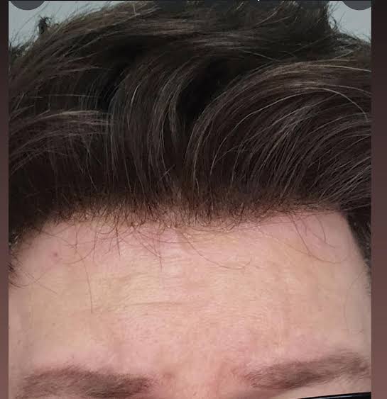 Natural hairline